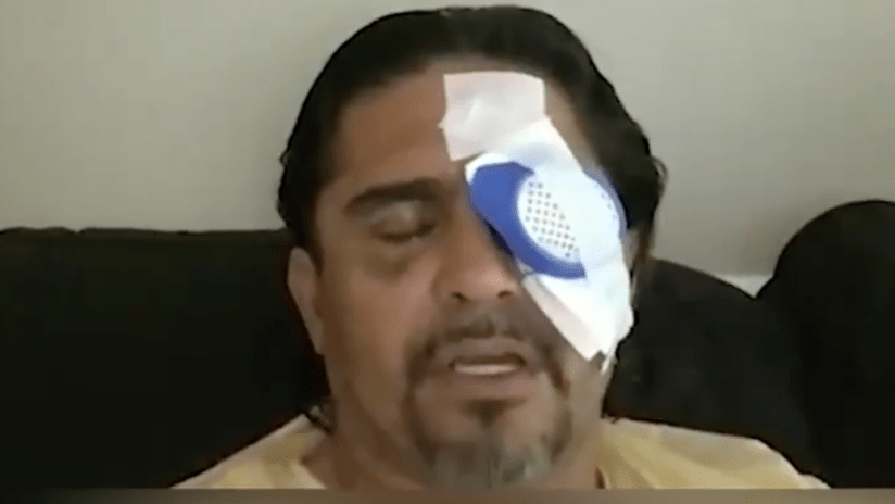 Jaime Moreno - eye accident - July 2020