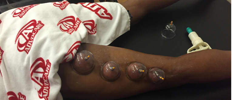 Still wondering what "cupping therapy" entails? You're years behind MLS - https://league-mp7static.mlsdigital.net/images/8-15-SJ-cupping-hammy.jpg