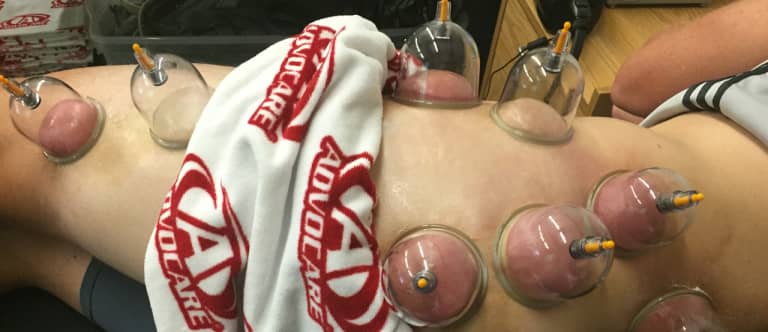 Still wondering what "cupping therapy" entails? You're years behind MLS - https://league-mp7static.mlsdigital.net/images/8-15-SJ-cupping-sideleg.jpg